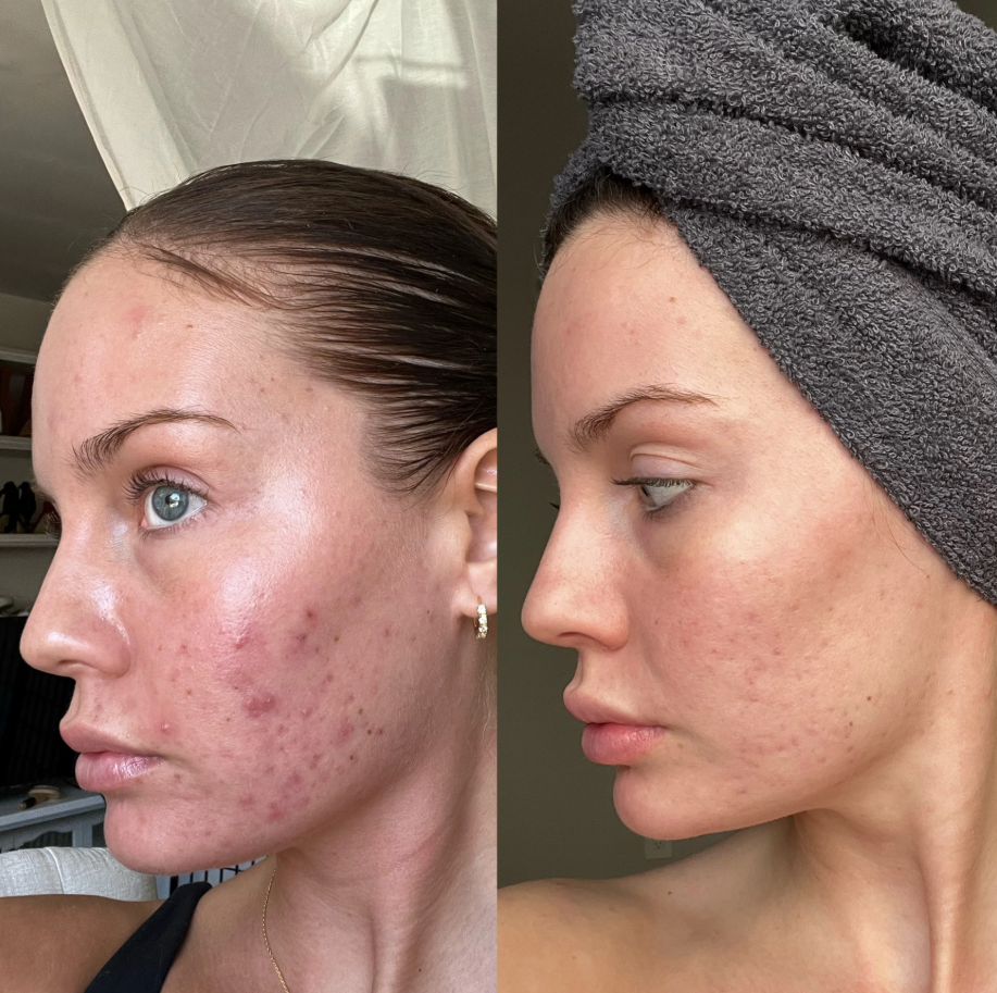 microneedle derma roller  image 2